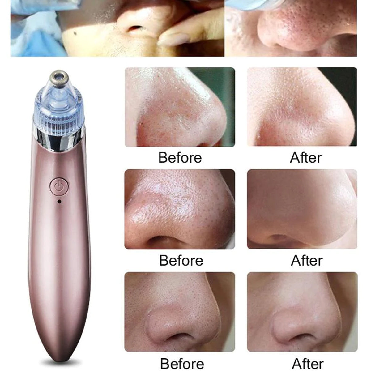 Derma Suction Blackhead Removal Machine 4 In 1 Machine