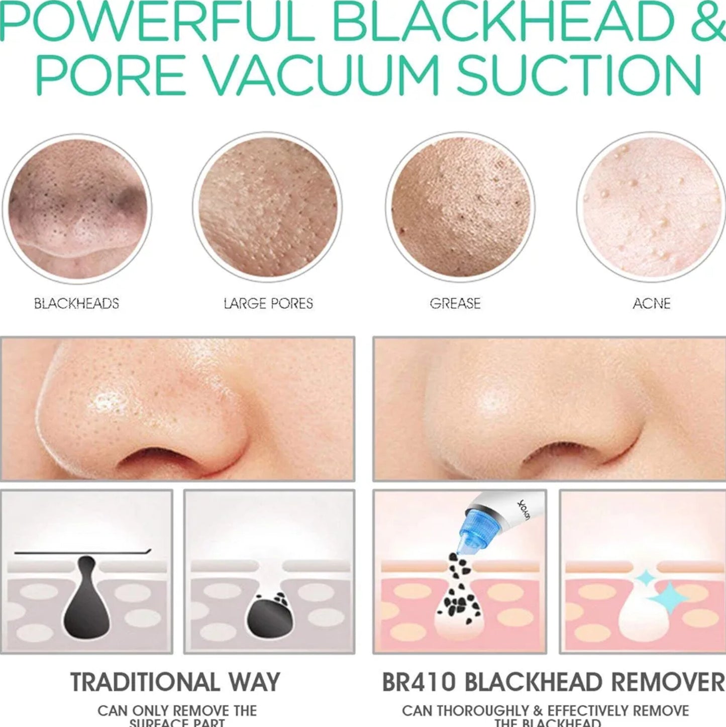 Derma Suction Blackhead Removal Machine 4 In 1 Machine